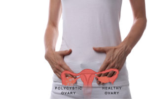 Polycystic Ovarian Syndrome (PCOS) Specialist